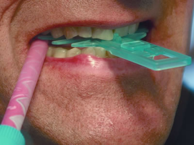 ERKODENT - SL Protrusion Gauge